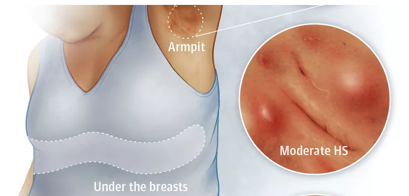 Hidradenitis Suppurativa on and Under the Breasts: Symptoms and Management