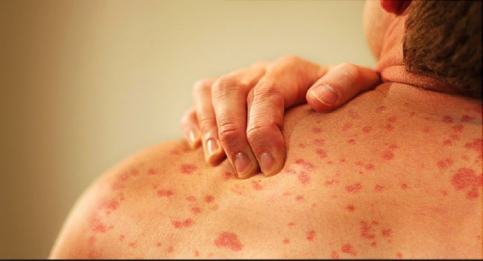 Severe Hives – AZIV Infusion Therapy Center